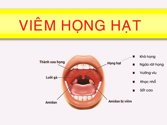 Viêm họng hạt