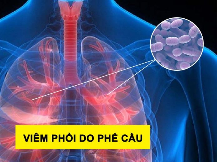 Viêm phổi do phế cầu